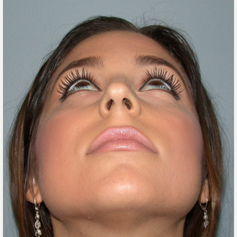18-24 year old woman treated with Rhinoplasty before 3685228