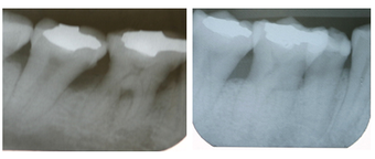 Bone Graft before 1008336