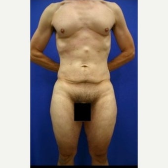 Male Body Lift before 1593006