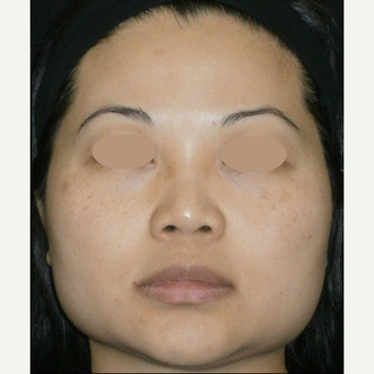 35-44 year old woman treated with IPL after 3091064