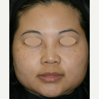 35-44 year old woman treated with IPL before 3091064