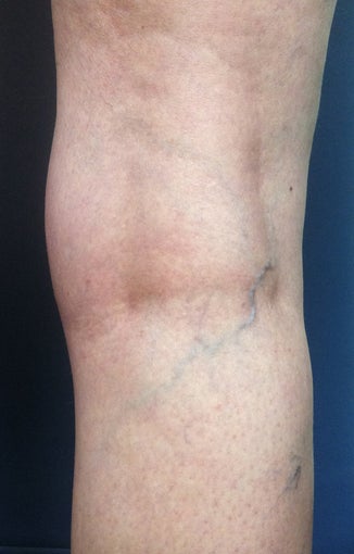 Before & After Leg Vein Treatment in San Diego before 931539