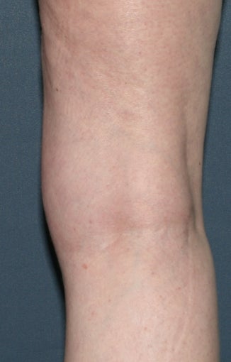 Before & After Leg Vein Treatment in San Diego after 931539