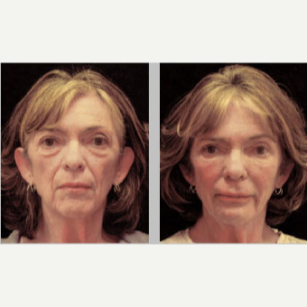 68 year old woman treated with Fat Transfer to her face. before 1602684