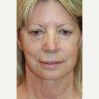 62 year old woman treated with Restylane Silk, Secondary Facelift, and Juvederm before 1782546