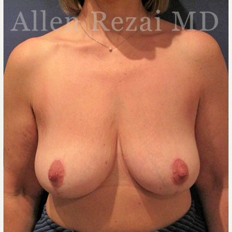 45-54 year old woman treated with Breast Lift/Uplift after 3751587