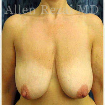 45-54 year old woman treated with Breast Lift/Uplift before 3751587