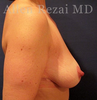 45-54 year old woman treated with Breast Lift/Uplift 3751587