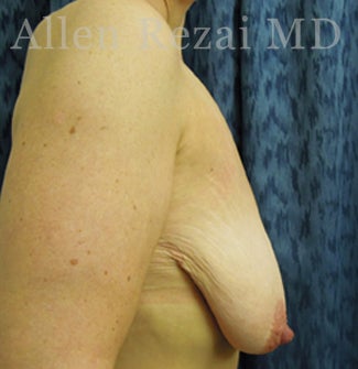 45-54 year old woman treated with Breast Lift/Uplift 3751587