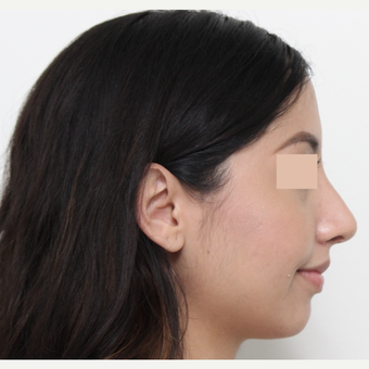 18-24 year old woman treated with Rhinoplasty after 3366356