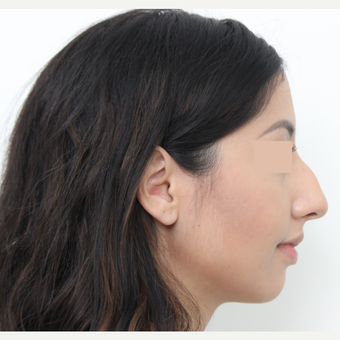 18-24 year old woman treated with Rhinoplasty before 3366356