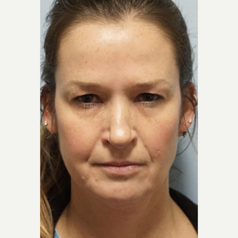 45-54 year old woman treated with Eyelid Surgery before 2983507