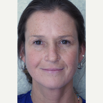 45-54 year old woman treated with Eyelid Surgery after 2983507