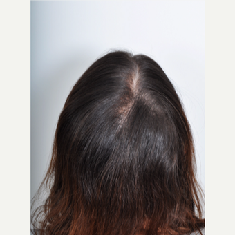 25-34 year old woman treated with PRP for Hair Loss after 2895350
