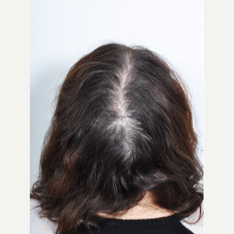 25-34 year old woman treated with PRP for Hair Loss before 2895350