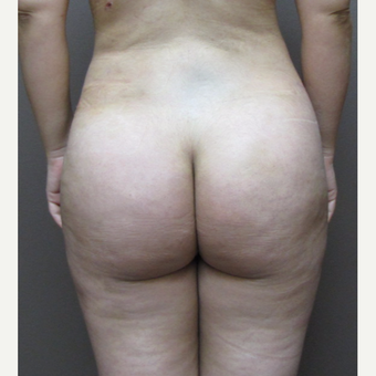 35-44 year old woman treated with Brazilian Butt Lift after 3213725