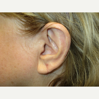 65-74 year old woman treated with Ear Lobe Surgery after 3725523