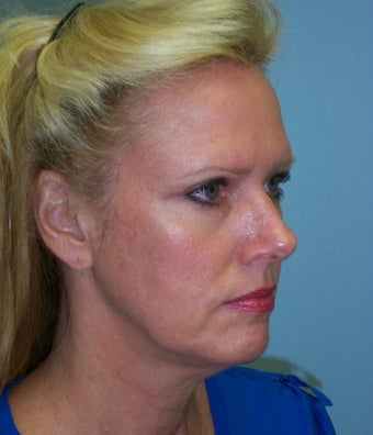 52 year-old woman who underwent facelift and necklift is seen before and one year afte surgery 1120807