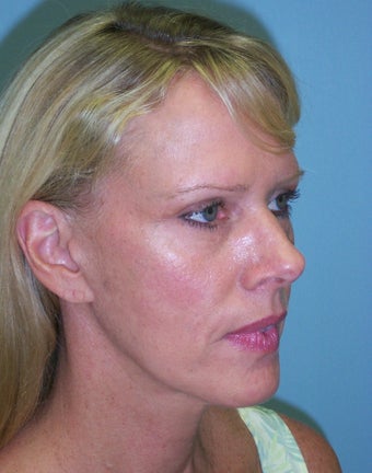 52 year-old woman who underwent facelift and necklift is seen before and one year afte surgery 1120807