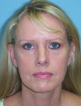 52 year-old woman who underwent facelift and necklift is seen before and one year afte surgery after 1120807
