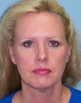 52 year-old woman who underwent facelift and necklift is seen before and one year afte surgery before 1120807