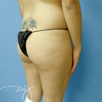 Butt Augmentation 877694
