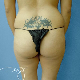 Butt Augmentation before 877694