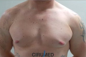 Ginecomastia Waterjet assisted liposuction supplemented with fat transfer to the upper part of the before 3025055