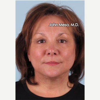 45-54 year old woman treated with Facelift, Neck Lift, Biplanar Endoscopic Brow Lift & Eyelids Lift after 2480792