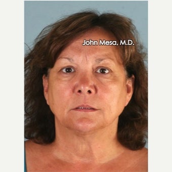 45-54 year old woman treated with Facelift, Neck Lift, Biplanar Endoscopic Brow Lift & Eyelids Lift before 2480792