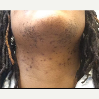 25-34 year old woman treated with Laser Hair Removal before 3443805