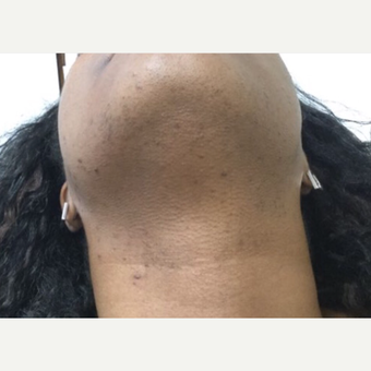 25-34 year old woman treated with Laser Hair Removal after 3443805