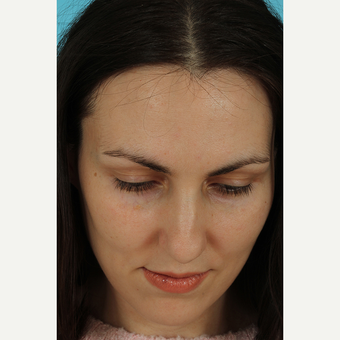25-34 year old woman treated with Rhinoplasty before 3690823