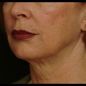 55-64 year old woman treated for Liquid Facelift after 1479661