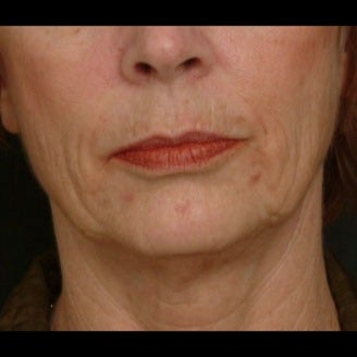 55-64 year old woman treated for Liquid Facelift 1479661