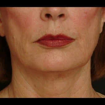 55-64 year old woman treated for Liquid Facelift 1479661