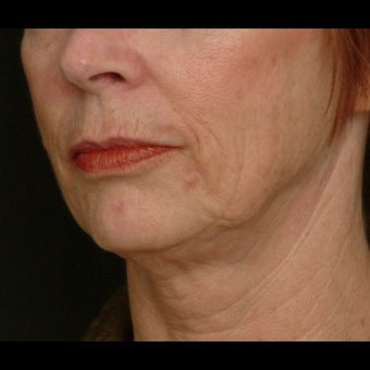 55-64 year old woman treated for Liquid Facelift before 1479661