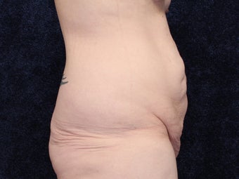 31 Year Old woman After Massive Weight Loss 1129880