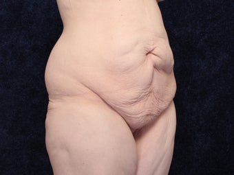 31 Year Old woman After Massive Weight Loss before 1129880