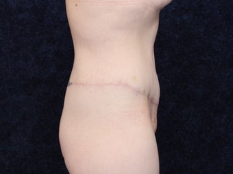31 Year Old woman After Massive Weight Loss 1129880