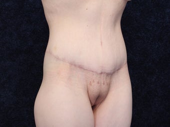 31 Year Old woman After Massive Weight Loss after 1129880