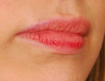 Restylane Lip Augmentation 492296
