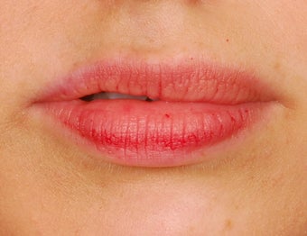 Restylane Lip Augmentation before 492296