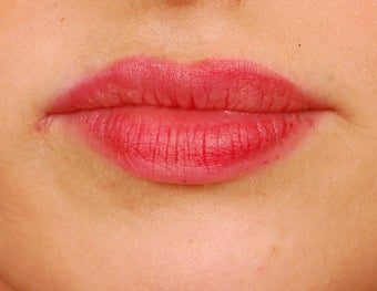 Restylane Lip Augmentation after 492296