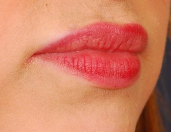 Restylane Lip Augmentation 492296