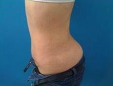 18-24 year old woman treated with Tummy Tuck and liposculpture after 1574162