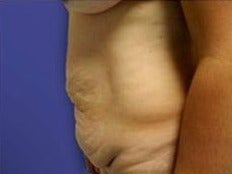 18-24 year old woman treated with Tummy Tuck and liposculpture before 1574162