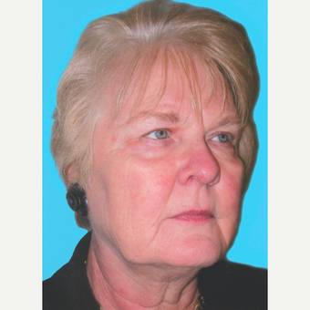 Facelift before 3826887