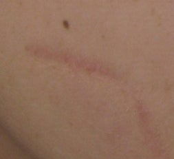 Traumatic Facial Scar after 6 Treatments with the 1540 Lux Fractional Laser before 52901