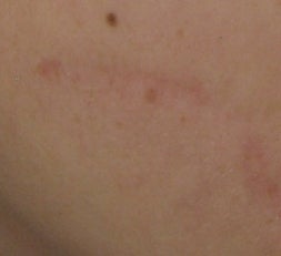Traumatic Facial Scar after 6 Treatments with the 1540 Lux Fractional Laser after 52901